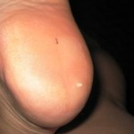 Bottom of Foot Pierced by Toenail Clipping, Feb. 2010